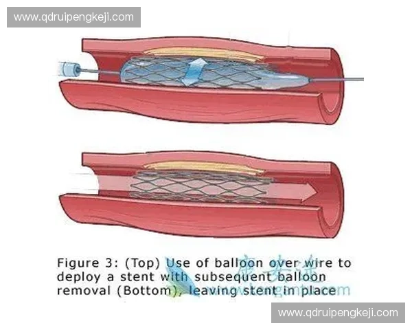 运动方向支架设计与应用研究创新发展趋势及挑战分析